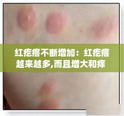 红疙瘩不断增加:红疙瘩越来越多,而且增大和痒